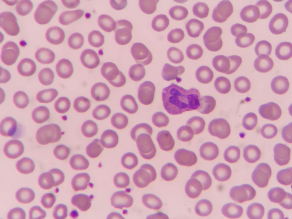 malaria